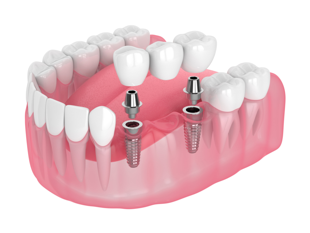 Dental Implants Beaconsfield and Dental Care in Mernda